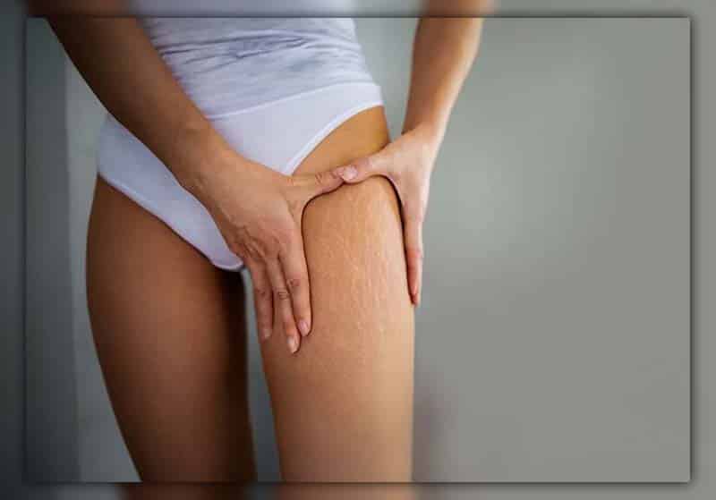 does losing weight get rid of cellulite