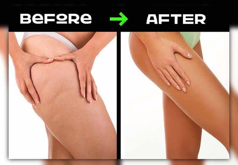 how to reduce cellulite in legs